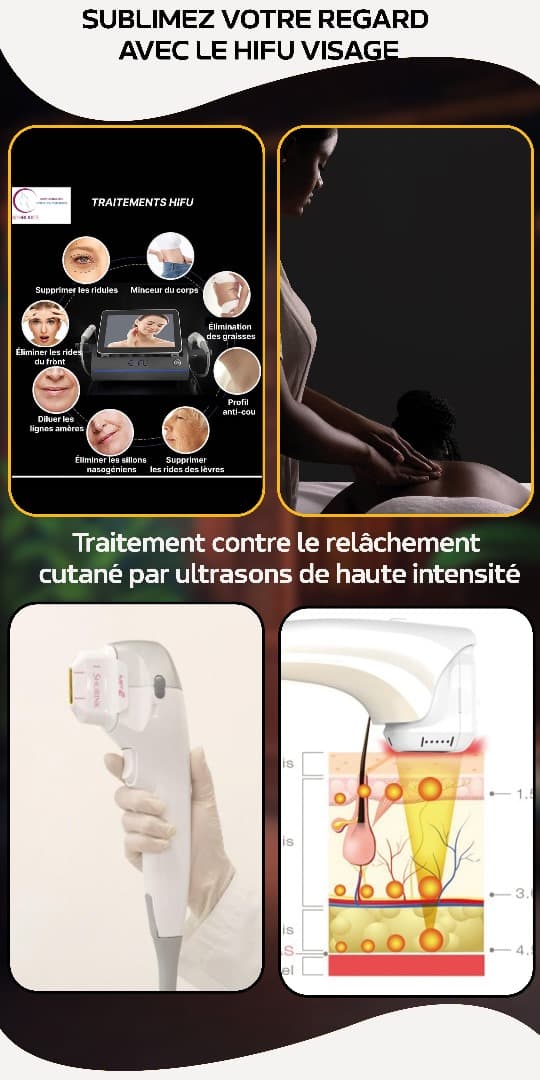 HIFU — Lifting non chirurgical